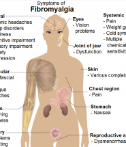 Symptoms_of_fibromyalgia