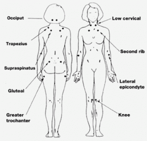 Diagnostic Criteria For Fibromyalgia